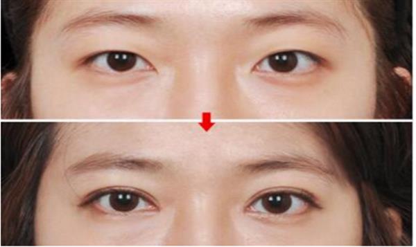 抽脂<a href=http://www.mx185.com/listinfo-708-0.html target=_blank class=infotextkey>去眼袋</a>术后效果怎样