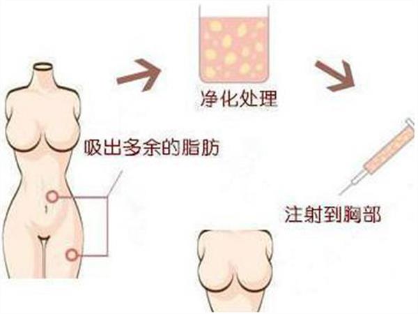 自体脂肪丰胸效果好吗