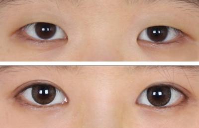 全切<a href=http://www.mx185.com/listinfo-724-0.html target=_blank class=infotextkey>双眼皮</a>术中过程如何？