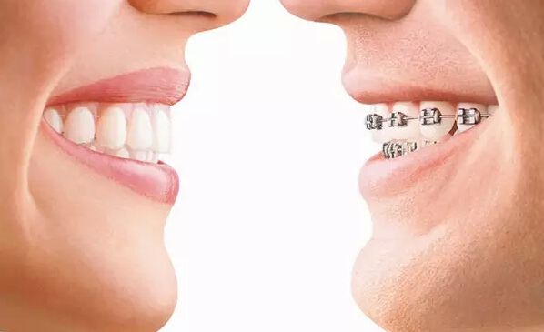 牙齿矫正前后对比图