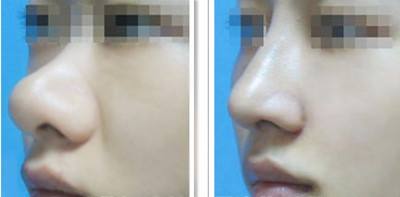 鼻头微整形多少钱