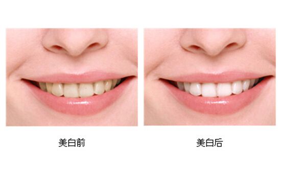 牙贴和冷光美白哪种好