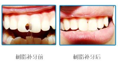 牙齿断了一半怎么修复