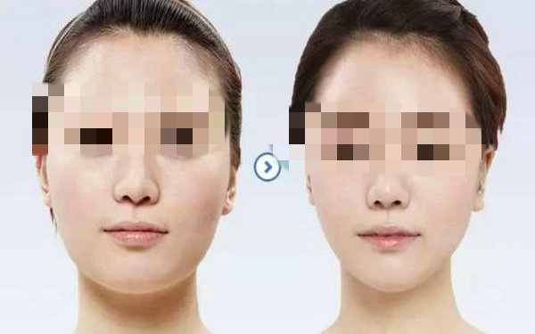 面部激光<a href=http://www.mx185.com/listinfo-682-0.html target=_blank class=infotextkey>溶脂</a>恢复期