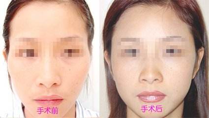 <a href=http://www.mx185.com/listinfo-690-0.html target=_blank class=infotextkey>自体脂肪填充</a>太阳穴照片