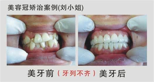 什么是美容冠矫正