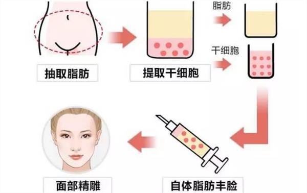 脂肪填充疼吗