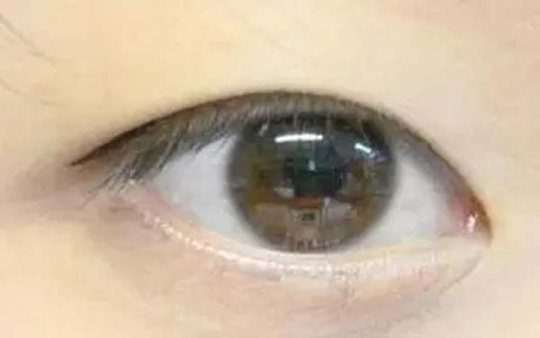 开眼角拆线疼吗