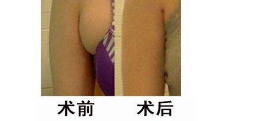 副乳切除手术几天恢复