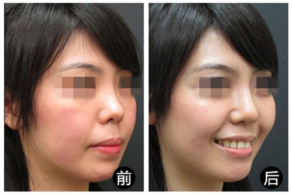 <a href=http://www.mx185.com/listinfo-737-0.html target=_blank class=infotextkey>隆鼻</a>一般价位