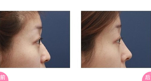 <a href=http://www.mx185.com/listinfo-737-0.html target=_blank class=infotextkey>隆鼻</a>一般价位多少钱