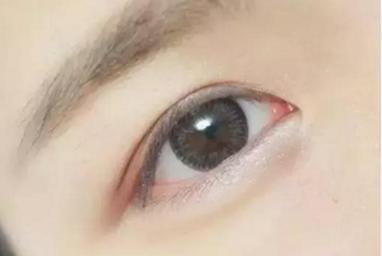 三点式双眼皮手术塑性会失败吗？