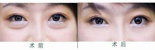 做外切眼袋多久能恢复