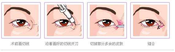 开眼角多久才能恢复