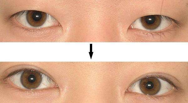 割<a href=http://www.mx185.com/listinfo-724-0.html target=_blank class=infotextkey>双眼皮</a>多少钱