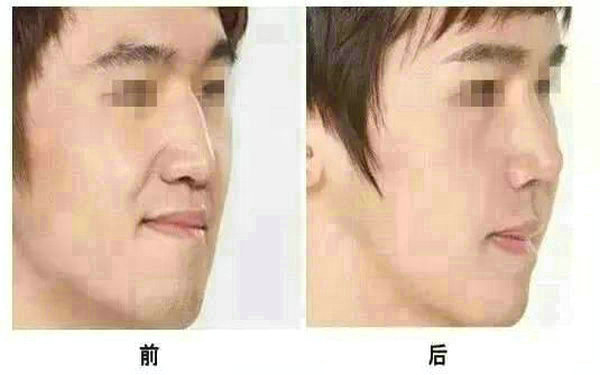 面部光纤<a href=http://www.mx185.com/listinfo-682-0.html target=_blank class=infotextkey>溶脂</a>会反弹吗?