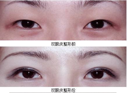 割<a href=http://www.mx185.com/listinfo-724-0.html target=_blank class=infotextkey>双眼皮</a>抽脂疼吗