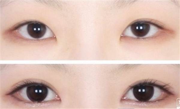 埋线法做<a href=http://www.mx185.com/listinfo-724-0.html target=_blank class=infotextkey>双眼皮</a>多少钱