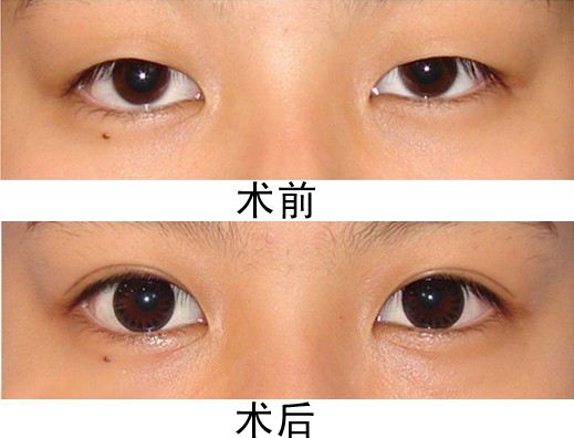 广州做<a href=http://www.mx185.com/listinfo-724-0.html target=_blank class=infotextkey>双眼皮</a>多少钱