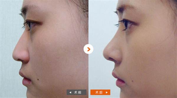 注射<a href=http://www.mx185.com/listinfo-737-0.html target=_blank class=infotextkey>隆鼻</a>的副作用