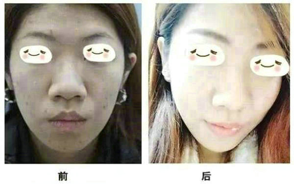 面部抽脂后注意事项?
