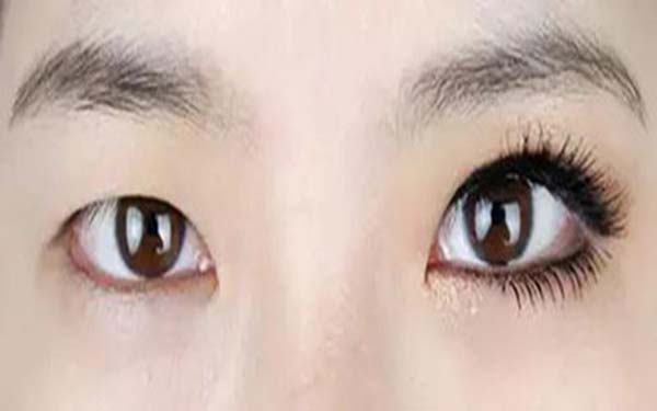 迷你切口法<a href=http://www.mx185.com/listinfo-724-0.html target=_blank class=infotextkey>双眼皮</a>手术简介