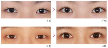 做<a href=http://www.mx185.com/listinfo-711-0.html target=_blank class=infotextkey>开眼角</a>手术完全恢复需要多长时间