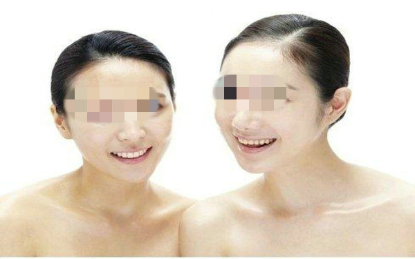 假体隆鼻多久能恢复