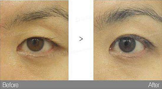 <a href=http://www.mx185.com/listinfo-724-0.html target=_blank class=infotextkey>双眼皮</a>紫色淤青怎么消