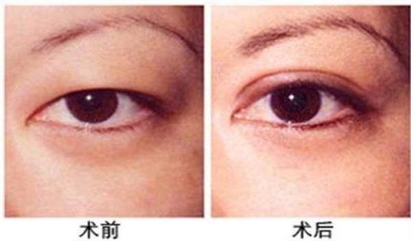 <a href=http://www.mx185.com/listinfo-724-0.html target=_blank class=infotextkey>双眼皮</a><a href=http://www.mx185.com/listinfo-685-0.html target=_blank class=infotextkey>吸脂</a>恢复过程图效果对比
