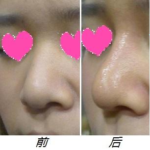 假体隆鼻恢复过程案例