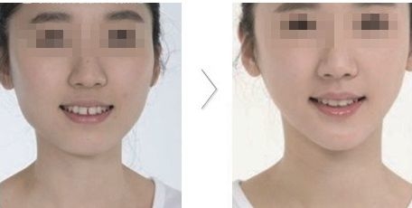 瘦脸有哪些方法
