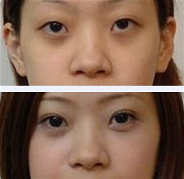 割双眼皮有疤怎么办