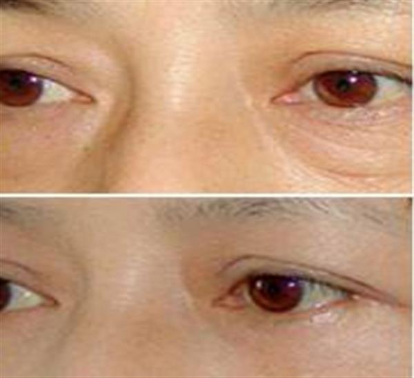 眼袋大了该怎么进行治疗较好