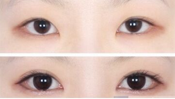 开眼角手术的费用