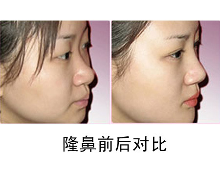 注射<a href=http://www.mx185.com/listinfo-737-0.html target=_blank class=infotextkey>隆鼻</a>术手术风险