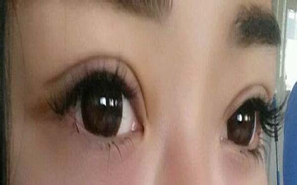 做个韩氏三点定位双眼皮多少钱?几天恢复