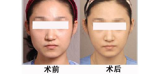学生<a href=http://www.mx185.com/listinfo-631-0.html target=_blank class=infotextkey>瘦脸</a>的较好方法