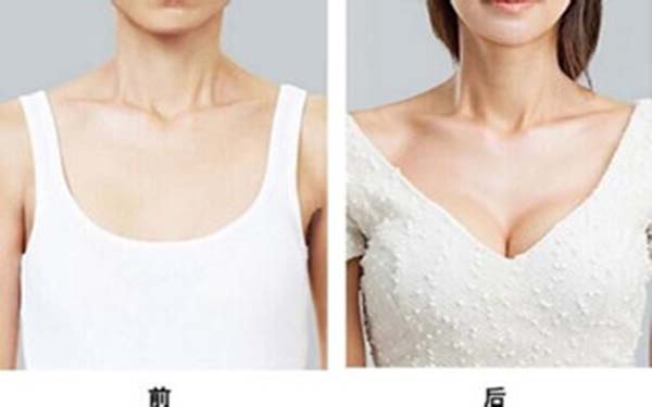 硅胶假体<a href=http://www.mx185.com/listinfo-618-0.html target=_blank class=infotextkey>隆胸</a>对哺乳有影响吗