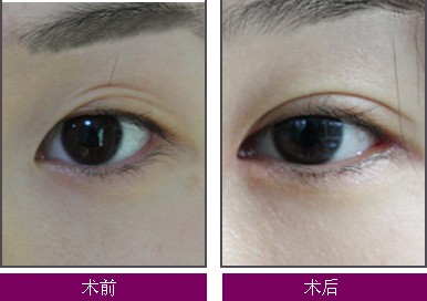 双眼皮埋线要费用大致是多少