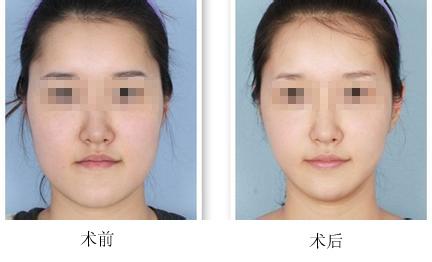 天津注射<a href=http://www.mx185.com/listinfo-631-0.html target=_blank class=infotextkey>瘦脸</a><a href=http://www.mx185.com/listinfo-614-0.html target=_blank class=infotextkey>除皱</a>价格