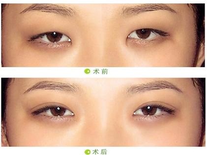 开眼角疤痕增生3个月恢复图片