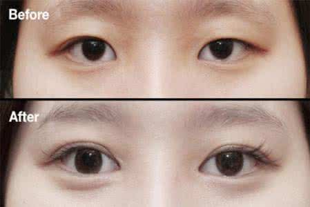 上海开眼角哪里好