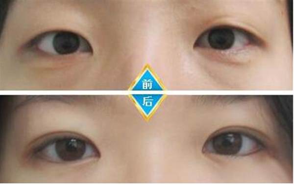 上海哪里可以开眼角
