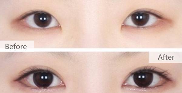 <a href=http://www.mx185.com/listinfo-711-0.html target=_blank class=infotextkey>开眼角</a>项目需要多少钱