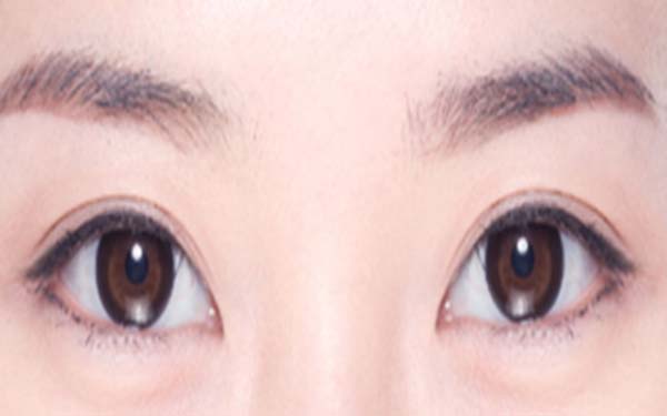 割完双眼皮多久可以怀孕